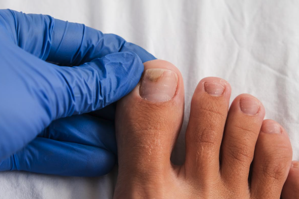 Nagelsvamp: Orsaker, symtom och behandling